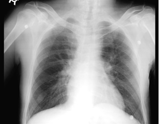 A Chest Xray