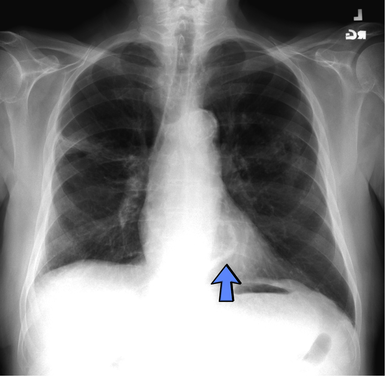 View Of Mitral Annular Calcification The Southwest Respiratory And