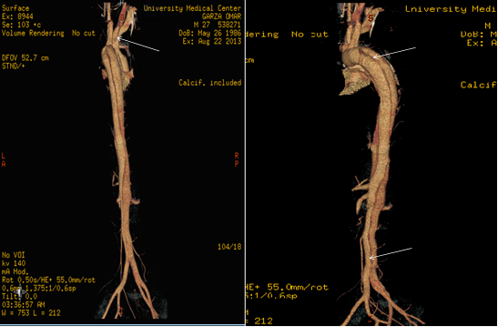 Aorta Artery Replacement Surgery