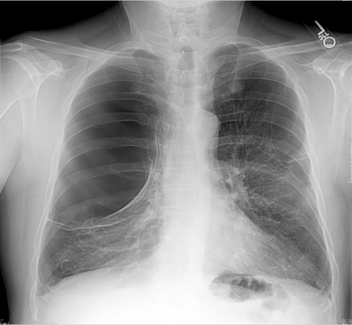 pulmonary bleb