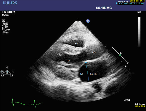 Normal Left Atrial Volume Echo