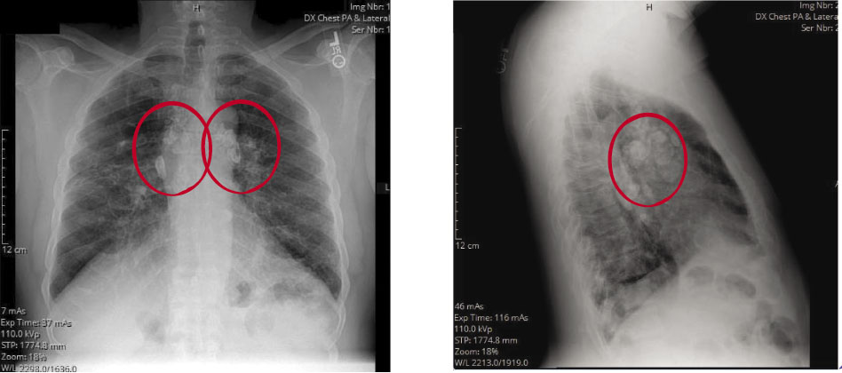 Eggshell Calcifications On A Routine Chest X Ray Green The
