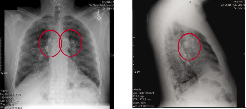 Eggshell Calcifications On A Routine Chest X ray Green The 